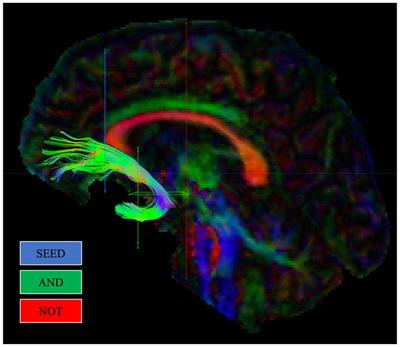Uncinate fasciculus microstructural organisation and emotion recognition in schizophrenia: controlling for hit rate bias
